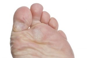 Treatment of corns and calluses at the Foot Specialists of Greater Cincinnati