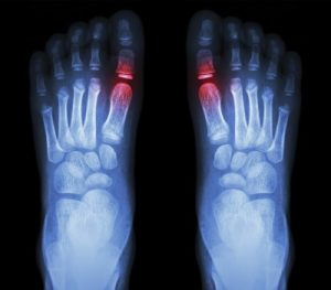 Cincinnati Hammer Toe Relief