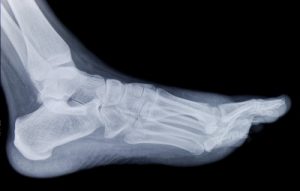 Foot and Ankle Fractures - Foot Specialists of Greater Cincinnati