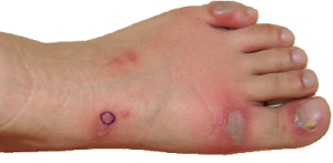 Treatment for Skin Lesions on Feet