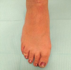 Bunion treatment and bunion relief at Foot Specialists of Greater Cincinnati