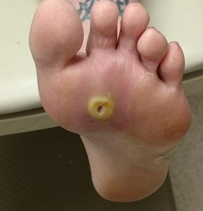 Diabetic feet and related complications including foot sores.