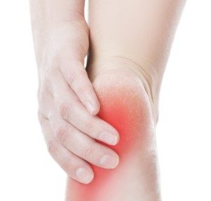 Heel pain controlled at the Foot Specialists of Greater Cincinnati