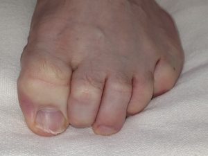 Hammer Toe treatment at Foot Specialists of Greater Cincinnati